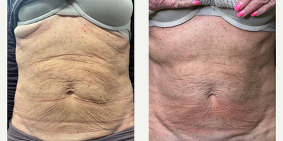 Woman treated with Sylfirm X - Woman treated with Sylfirm X