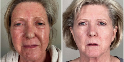 Woman treated with IPL - Woman treated with IPL