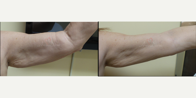 55-64 year old woman treated with Ultherapy - Skin tightening and cellulite treatment with Venus Freeze (radiofrequency)