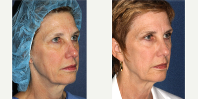45-54 year old woman treated with Deep FX - Signs of aging are minimized using Active/Deep FX laser treatment