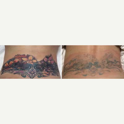 25-34 year old woman treated with Enlighten - Just 4 Enlighten Laser Tattoo Removal Treatments