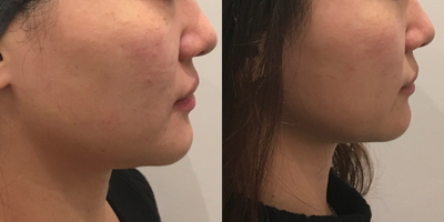 25-34 year old woman treated with Thermage FLX - age 25-34 years old woman treated with Thermage FLX on lower face