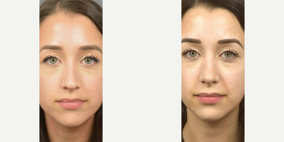 Woman treated with Revision Rhinoplasty - We checked in with this patient at her 6 month Post-Op appointment -- here's how she's doing now at 1 year.Revision Rhinoplasty is a surgery is used to repair undesirable effects from a previous nose job, most often with another physician. Not all plastic surgery procedures provide the results you desire, whether because the surgeon is inexperienced or unforeseen complications may arise. Revision rhinoplasty works to correct these undesired effects as much as possible, sometimes by grafting ear or rib cartilage if there isnt enough septal cartilage present to support the nasal structure. Revision rhinoplasty can be very complex  depending on the amount of scar tissue present and the preservation of the original nasal structure  and can last up to five hours. The risk of needing revision rhinoplasty is significantly reduced by seeing a board-certified facial plastic surgeon in the first place, so it is vital that you do your due diligence when choosing your surgeon.
