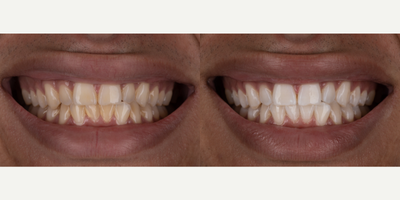 18-24 year old man treated with Zoom Whitening - This patient had never had teeth whitening done before and his starting natural shade was relatively dark. Using in-office Zoom! Whitening we were able to lighten his smile significantly with one appointment.