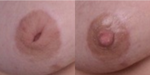 25-34 year old woman treated with inverted nipple repair - This patient is a 26 year old female who is 4 months post inverted nipple repair and doing well. This procedure can be performed with local anesthesia and has minimal downtime.