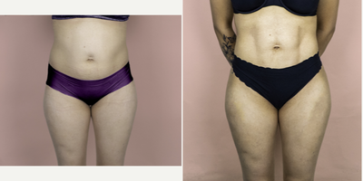 25-34 year old woman treated with Brazilian Butt Lift - Brazilian butt lift. Four months post-op.