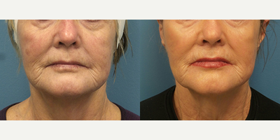 72 year old woman treated with Silhouette InstaLift - This patient was concerned with facial laxity. She was treated with the Silhouette Instalift