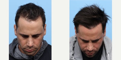 45-54 year old man treated with FUE Hair Transplant, Hair Transplant, Hair Loss Treatment, PRP for Hair Loss, PRP Injections - Dr. Wise performed an FUE hair transplant on this patient, placing 3,050 grafts to restore his hairline and add density. In addition, he performed one treatment of PRP therapy to expedite the healing process and fortify the follicles.