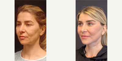 Woman treated with Neck Lift - Woman treated with Deep Plane Facelift, Neck Lift, and Lateral Brow Lift. Post-op, she looks fresh and contoured without any pulling or stigmata.