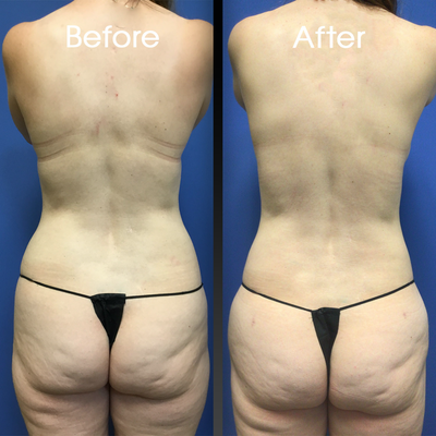 35-44 year old woman treated with Mommy Makeover - This beautiful mommy makeover consisted of a breast augmentation and lipo of her abdomen and flanks.