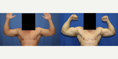 45-54 year old man treated with Vaser Liposuction - This is a 45-year-old Latino male patient with an initial weight of 326 pounds.  He underwent a significant weight loss journey where he successfully shed 146 pounds. As part of his transformation, the patient desired to achieve more toned and muscular arms.	To fulfill his aspirations, he chose to undergo VASER liposuction of the arms under the expert care of Dr. J. Timothy Katzen in Beverly Hills, CA. VASER liposuction is a procedure that utilizes ultrasound technology to remove excess fat cells and improve contouring and musculature in the treated area.	Following the procedure, the patient's arms showcased a noticeable enhancement in muscle definition and tone, aligning with his desired outcome. The patient expressed extreme satisfaction and happiness with the results of the VASER liposuction, further boosting his confidence and overall well-being.	It is worth noting that individual experiences may vary, and the positive outcome experienced by this patient may not reflect the experiences of others.