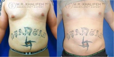 Man treated with Liposuction - Man treated with Liposuction