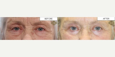 Woman treated with Ptosis Surgery - Woman treated with Ptosis Surgery