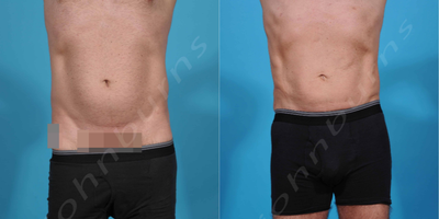 35-44 year old man treated with Laser Liposuction - Abdomen, flanks, chest
