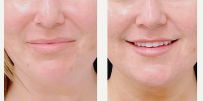 Woman treated with AviClear - AviClear significantly eliminates acne in three, quick 30-minute treatment sessions. And results continue to improve over time! .