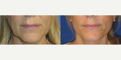 Woman treated with Neck Lift - Ever wondered how a FACEologyLIFT stands out from a traditional facelift?Our approach is less invasive, reducing risks to muscles and nerves, with discreet incisions hidden in the hairline and natural borders of the ear. The healing incisions blend seamlessly, becoming nearly invisible.We still tighten the SMAS layer and remove excess skin for a beautifully defined jaw and neckline, but the results are more natural, and recovery is quicker and easier. Unlike traditional facelifts, ours takes 1.5 to 2 hours under local anesthesia and oral sedation, making it a safer and more comfortable experience.No need for hospital stays; our FACEology LIFT is performed in an outpatient accredited surgery center. Choose the modern, more natural approach to facial rejuvenation with Dr. Lees FACEologyLIFT in Newport Beach