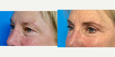 55-64 year old woman treated with Eyelid Surgery - Upper Blepharoplasty