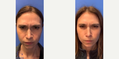 Woman treated with Botox - Woman treated with Botox