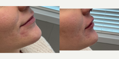 18-24 year old woman treated with Restylane Kysse - The doctoradded volume and enhanced the shape of this 24-year-old patients lips with Restylane Kysse.