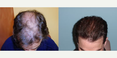 Hair Transplants - Male Patient suffering from Male Pattern Baldness (Alopecia)