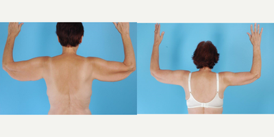 55-64 year old woman treated with Arm Lift - A 61 year old woman before and after Brachioplasty by Andrew T. Lyos M.D FACS. She had underwent a gastric sleeve operation and lost about 87 pounds.