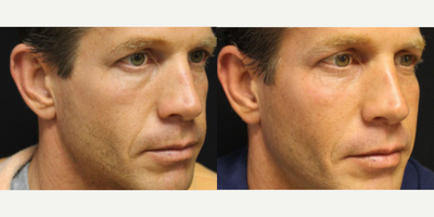 Man treated with Bellafill - Bellafill