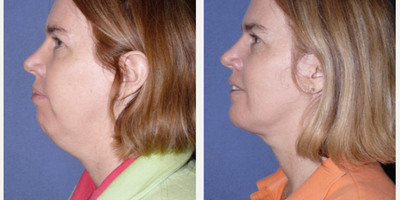 Woman treated with Liposuction - Woman treated with Chin Liposuction as well as Neck Lift and Chin Implant to address excess skin on her neck, fats and neck muscle (platysma) for a profound change in neck and chin area.