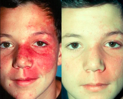 PDL Treatment for Port Wine Stain  - 	Young boy before and after pulsed dye laser treatment for port wine stain on his face.