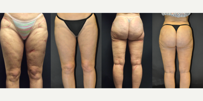 45-54 year old woman treated with Liposuction Revision - 51-year-old woman s/p previous liposuction of thighs with contour irregularities of thighs, over resection of lateral femoral, infragluteal areas, depressions of left anterior thigh, excess untreated buttock fat, and residual fat in circumferential thighs.Treatment consisted of circumferential liposuction of the thighs, buttock, knees and upper calves; microfat transfer to the anterior thigh deformities and lateral buttock hollows, inferolateral buttock depressions and infragluteal  areas of previous over-resection. Total aspirate 2700 cc. Total fat grafted 650 cc.
