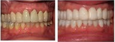 Whiter Smile - We can see the dramitc increase in brightness for a whiter smile after a zoom Procedure