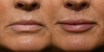 55-64 year old woman treated with Restylane Refyne, Lip Fillers, Restylane, Dermal Fillers - This patient wanted her lips to look as natural as possible with a slight plumping. We're able to achieve this look with Restylane Refyne and she could not stop smiling when she left our office! Another happy patient here at South Shore Plastic & Reconstructive Surgery!