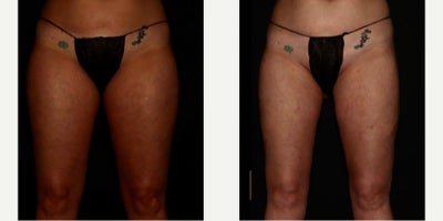 45-54 year old woman treated with Lipedema Surgery - Lipedema surgery to Inner and anterior thighs on a stage 1 Lipedema patient