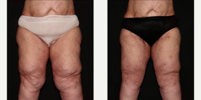 45-54 year old woman treated with Lipedema Surgery - Lipedema surgery to Inner and anterior thighs on a stage 3 Lipedema patient