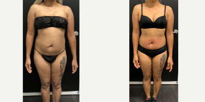 35-44 year old woman treated with JuVaShape - V Shape Ultra/Juvashape by Alma Lasers abdominal radiofrequency skin tightening and ultrasound shock fat destruction. The area treated is outlined in red.