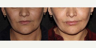 25-34 year old woman treated with Chemical Peel, SkinPen, DiamondGlow - Patient was treated for sun damage and acne using PRP SkinPen, Chemical peels, and finishing with a DiamondGlow Facial.