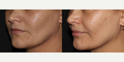 25-34 year old woman treated with Chemical Peel, SkinPen, DiamondGlow - Patient was treated for sun damage and acne using PRP SkinPen, Chemical peels, and finishing with a DiamondGlow Facial.