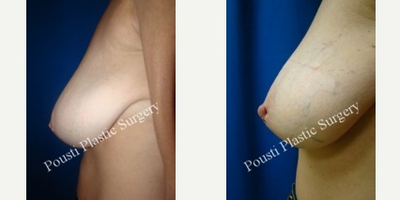 45-54 year old woman treated with Nipple Surgery - This 54 year old female has been considering repairing her inverted nipples for weeks. She decided to make the procedure a reality and began to research online for plastic surgeons in her area that could help correct her issue. She came across a plastic surgeon in her area that she was interested in. She wanted to pick his brain about the procedure and she decided to schedule a consultation with him. She met with him and he deemed her an excellent candidate for this procedure. They discussed the procedure in detail and decided to proceed with surgery soon thereafter. The next week she came in for her in-office nipple repair. She is currently 9 days post inverted nipple repair.