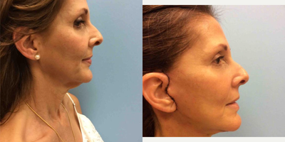 45-54 year old woman treated with Facelift - Patient 3 days after a full face and neck lift. Quick recovery with excellent results .&nbsp;