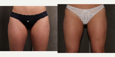 25-34 year old woman treated with Profound RF - Inner thigh area treated one time with Profound RF to slim legs and improve thigh gap