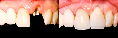 Dental Crown Procedure Before and After - 30-35 year old female patient treated with a Dental Crown