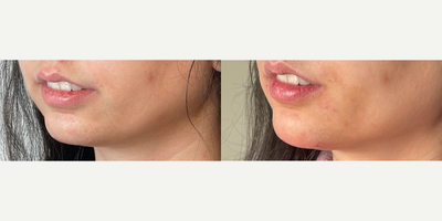 18-24 year old woman treated with Chin Filler - 2 syringes of Restylane Defyne to enhance her chin.