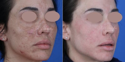 35-44 year old woman treated with Accutane, Chemical Peel, YAG Laser - 35-44 year old woman treated with Medical Grade Topicals, Accutane, Chemical Peel, & Laser
