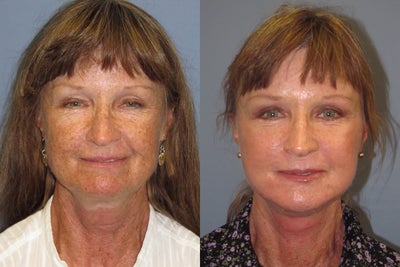 59 year old Blue Peel ,Lite Lift  - 	Blue Peel and Lite Lift on 59 year old female notice the dramatic improvement in her skin tone and texture.