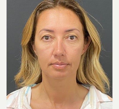 35-44 year old woman treated with Brow Lift - Brow Lift