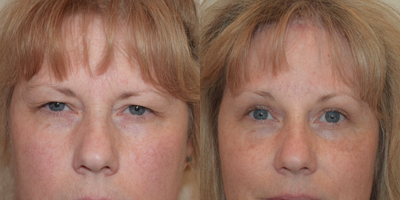 57 year old woman treated with Brow Lift and upper eyelid blepharoplasty - This 57 year-old pleasant female presented with a chief complaint of visual field obstruction.  She complained of a heavy feeling and tiredness on her eyes resulting from laxity and drooping of her upper eyelids and eyebrow.  She complained of difficulty seeing to the sides especially while driving and also the constant urge to consciously raise her eyebrow in order to see better.  On 02/10/16, she underwent an upper eyelid blepharoplasty and transfollicular subcutaneous brow lift.  The after photos presented here were taken on 04/15/16.  Because of the severity of her condition, her health insurance covered the upper eyelid blepharoplasty portion of the procedure.  Her eyebrow pre-operatively does demonstrate drooping, however her eyebrow is still above the supraorbital rim and she would have still benefitted significantly from the upper eyelid blepharoplasty alone.  The patient desired a more complete and aesthetically pleasing result and therefore consented to a browlift which was performed in conjunction with the upper eyelid blepharoplasty procedure.
