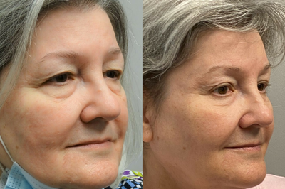 Woman treated with CO2 Laser - Endoscopic forehead and brow liftBlepharoplasty of both upper lidsTransconjunctival excision herniated orbital fat with CO2 laser skin resurfacing of both lower lids