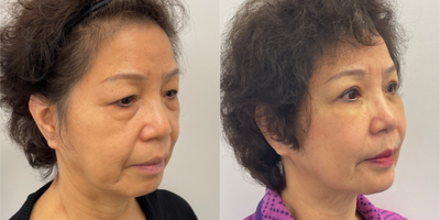 65-74 year old woman treated with Eyelid Surgery, Facial Fat Transfer - My 71 year old patient is 2 weeks out from and Upper and Lower eyelid blepharaoplasty and a facial fat transfer.