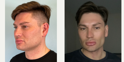 3 Weeks Post- Op: Buccal Fat Removal, Jawline Sculpting and Perioral Mound - 35-44 year old man treated with Buccal Fat Removal, Jawline Sculpting and Perioral Mound