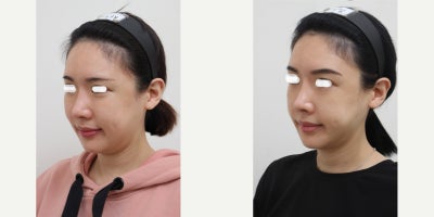 25-34 year old woman treated with AccuLift, Liposuction, Laser Liposuction - 26 Years old female patient Chief Complain: Puffiness and the lack of jaw contours, round shaped face (looking for V-line) Treatment Plan: ace liposuction (double chin, cheek bone, cheeks, near mouth)Outcome: pure fat liposuctioned : double chin (-20cc), middle face line (- 40cc) fresher look, V-lined face shape, more refined appearance