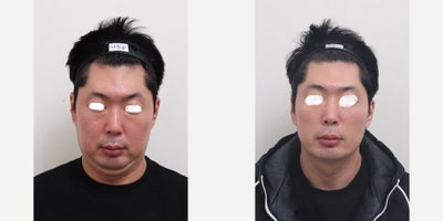 35-44 year old man treated with AccuLift, Liposuction, Laser Liposuction - 39 Years old male patient Chief Complain: Bulky cheeks, overal puffiness and the lack of masculine contours, looking gloomy and more older then his real age. Puffy, tired undereye areaTreatment Plan: undereye fat reposition, face liposuction (double chin, cheek bone, cheeks, near mouth)Outcome: pure fat liposuctioned : double chin (-30cc), middle face line (- 50cc) fresher and more youthful face shape, reduce exessive fat, more refined appearance and masculine shaped jaw line.